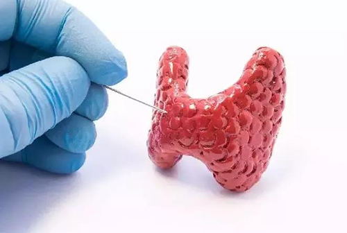 甲状腺疾。鬃聪俟δ芗跬撕图鬃聪俟δ芸航，自古以来就是反复被医学研究人员研究的疾病