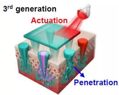 第三代：通过微针介导的皮肤层破坏和微针伴随的各种功能增强药物转运.jpg